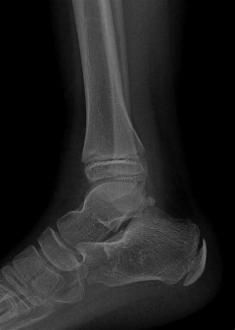 sağlam ayak bileği röntgeni
